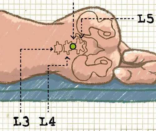 Spinal Puncture Illustration