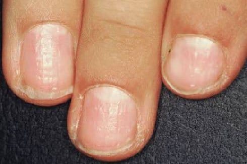 Psoriatic Arthritis Nail Damage: Symptoms and Treatment