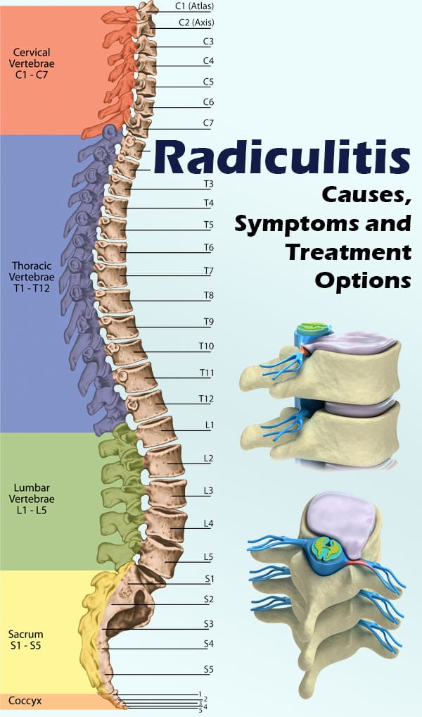 Radiculitis – Causes, Symptoms and Treatment Options-p