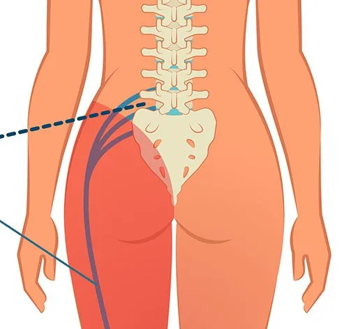 Sciatica