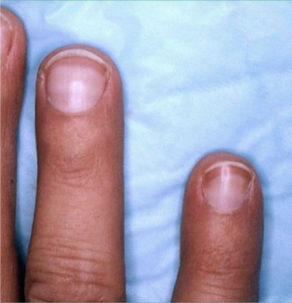 Nail Assessment | PDF | Nail (Anatomy) | Rtt