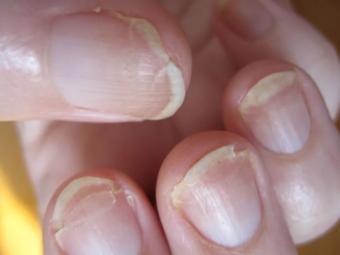 cracked-fingernail