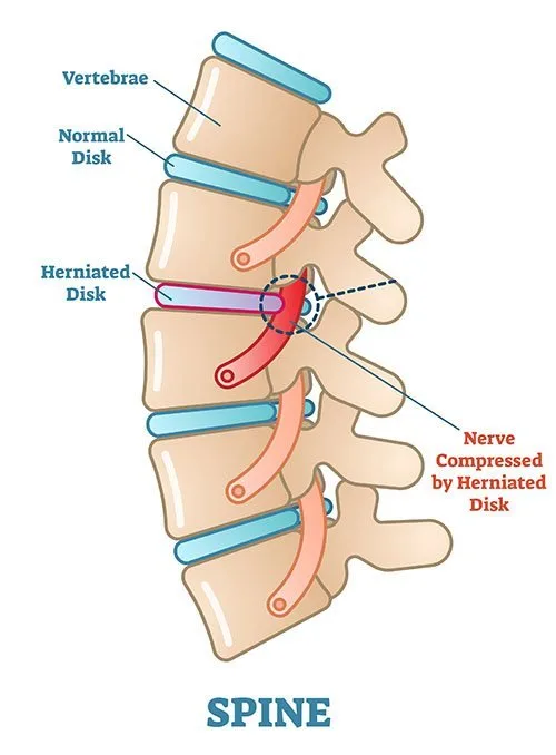 Sciatica
