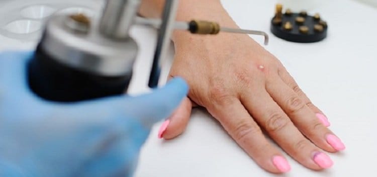 wart-removal