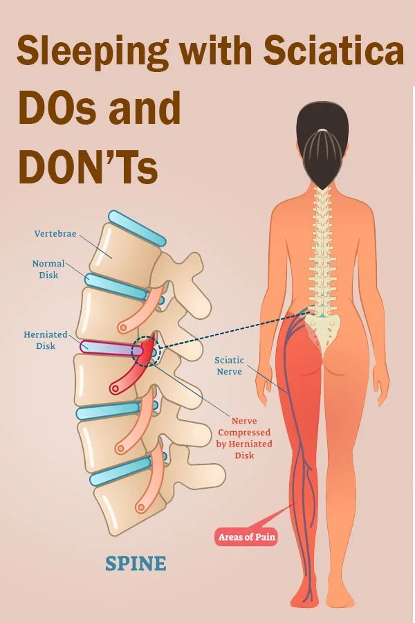 sleeping with sciatica p
