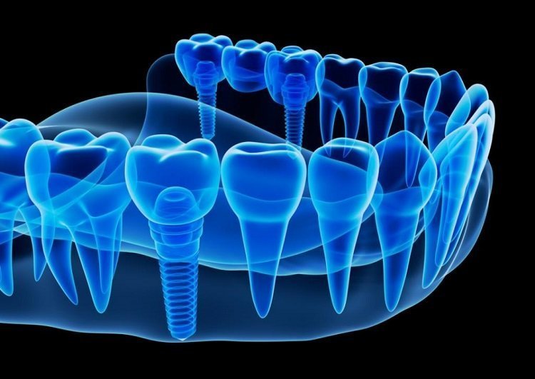 teeth-implant