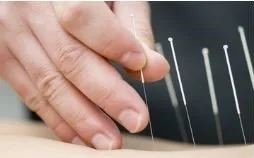 acupuncture1