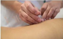 acupuncture2