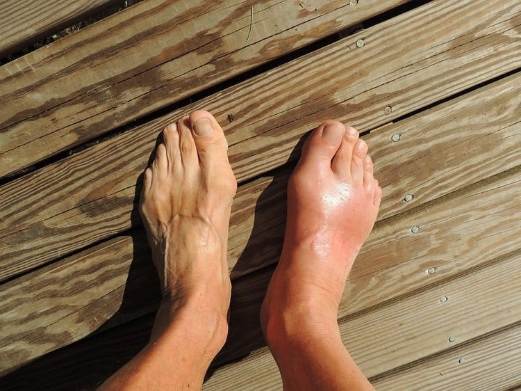 swelling-foot