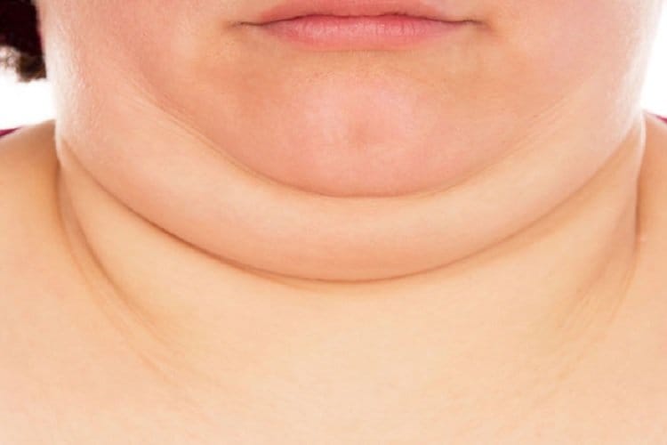 Double Chin