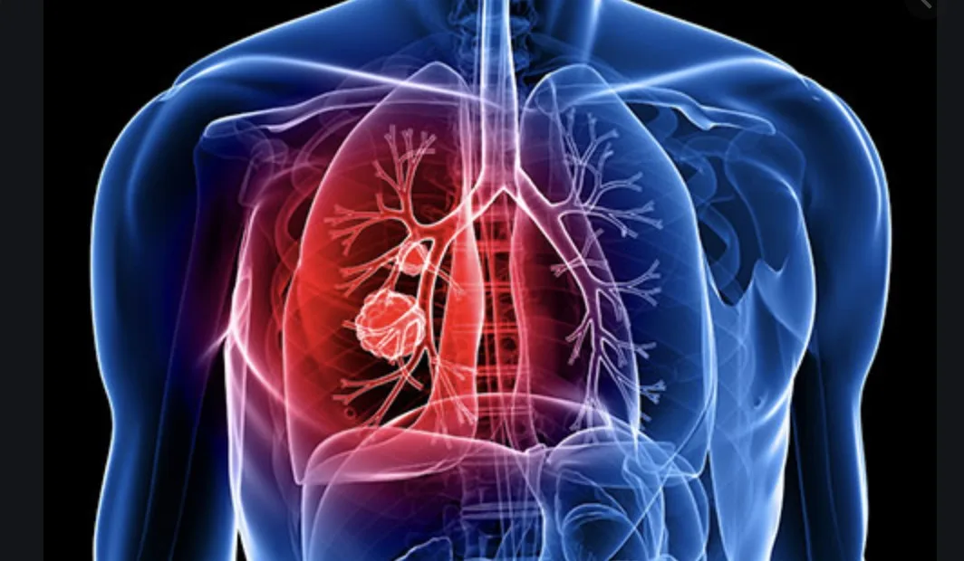 Therapy for Cancer Treatment