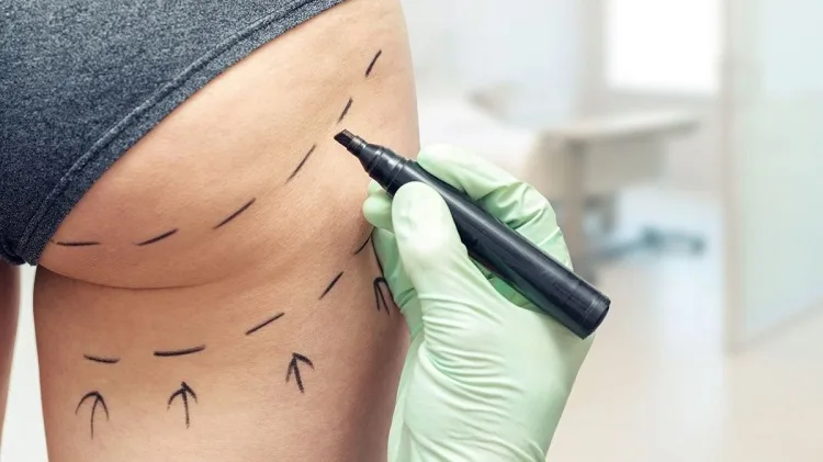 surgery butt plastic