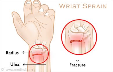 wrist-sprain