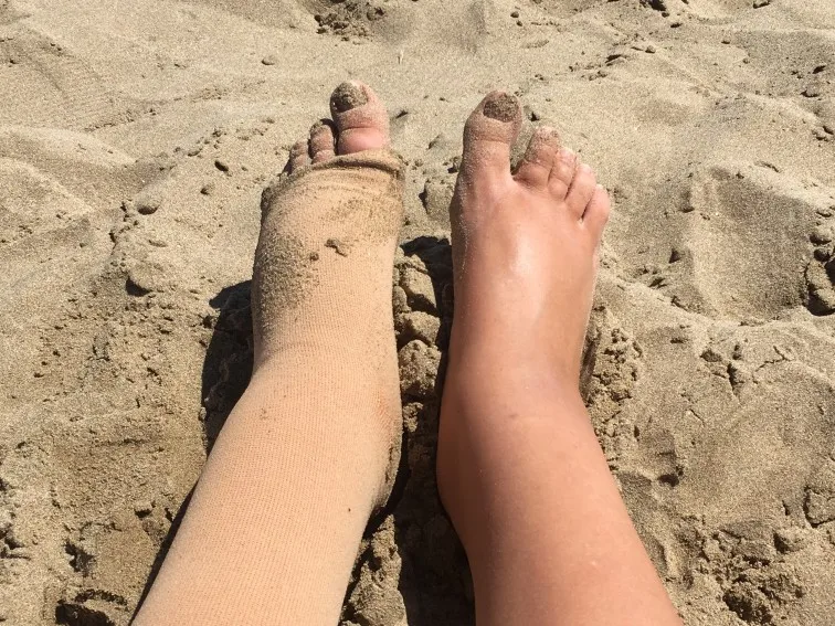 Lymphedema