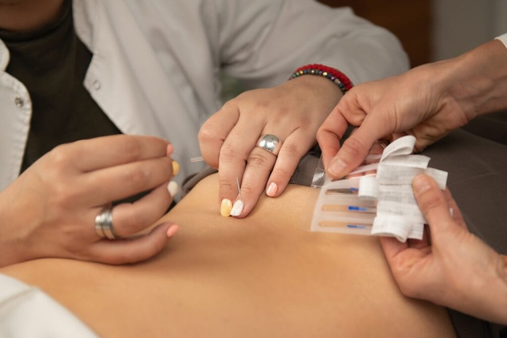Benefits of Acupuncture